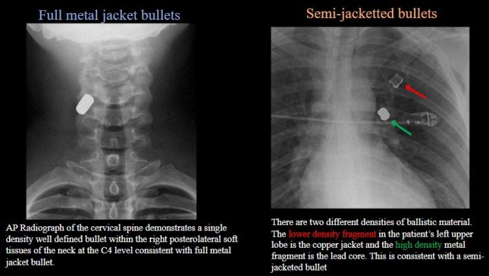 ARRS Annual Meeting Delivers Updated Primer on Imaging Ballistic